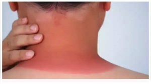 Don't Ignore These: 5 Subtle Skin Cancer Signs You Might Be Missing