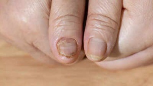 Fragile Nails? What Your Breaking Nails Could Be Telling You About Your Health