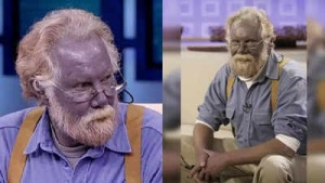 Rare 'Smurf Syndrome' Turns Skin Blue-Gray: Understanding Argyria Symptoms, Causes and Prevention
