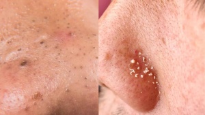 Blackheads vs. Whiteheads: The Ultimate Guide to Understanding, Treating, and Preventing Stubborn Blemishes